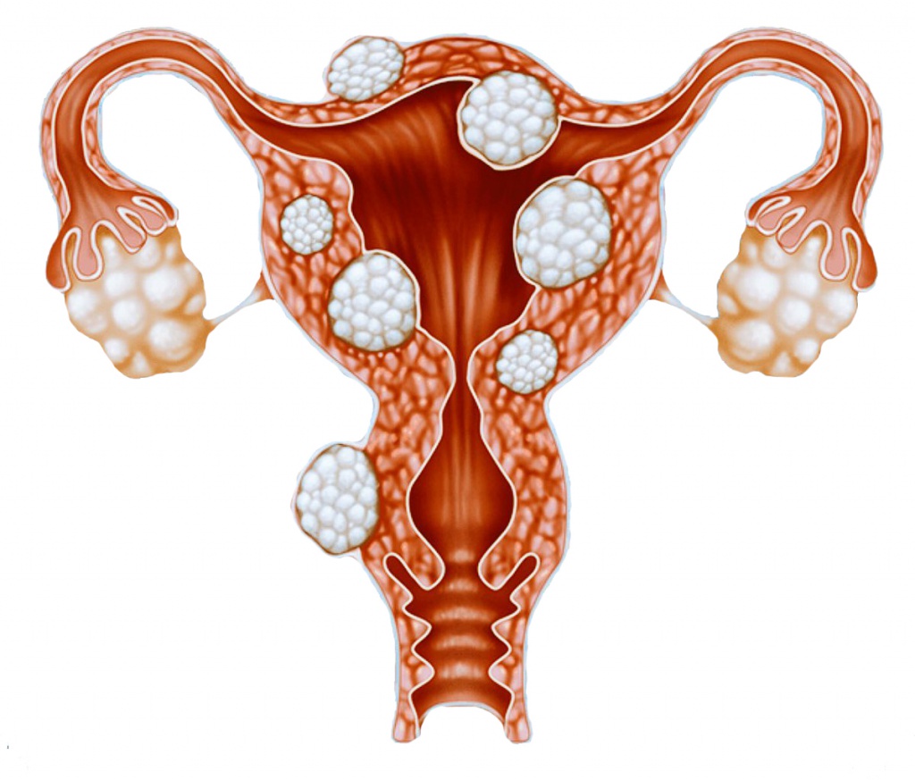 Субсерозная миома матки