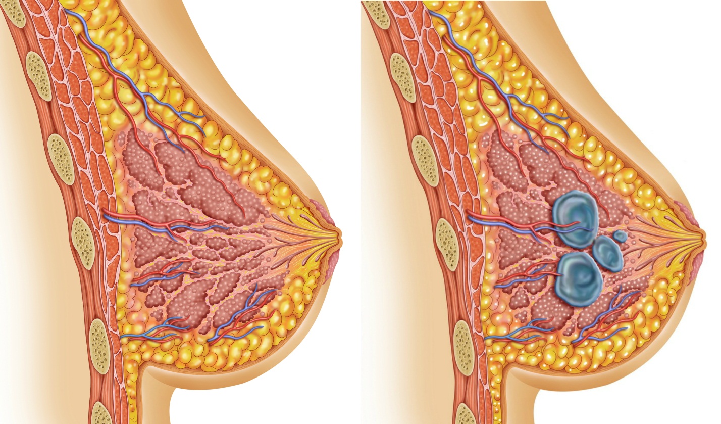 Миома матки и мастопатия: в чем схожесть патологий?