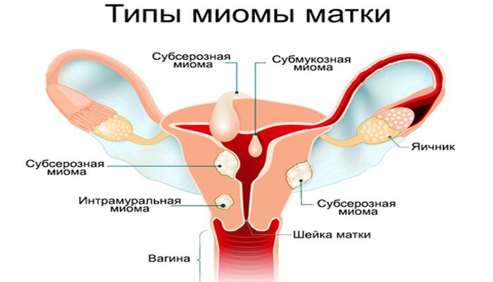 Воспаление миоматозных узлов при беременности thumbnail