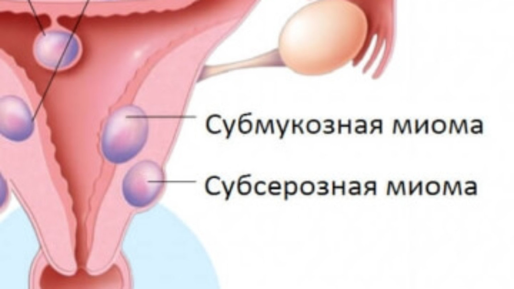 Субмукозная миома (фибромиома, лейомиома) матки